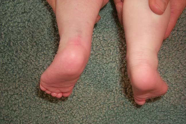 3 weeks after tenotomy