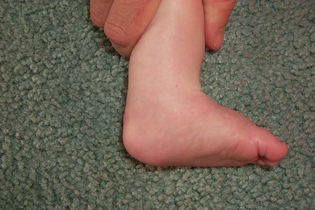 3 weeks after tenotomy