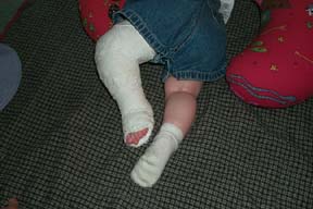 First Ponseti cast-July 17