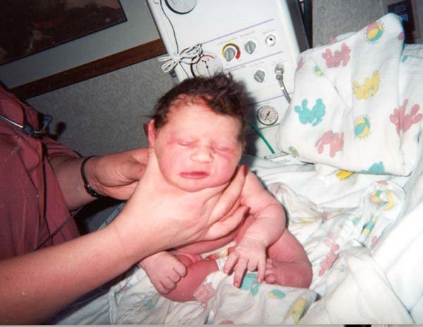 Clubfoot at birth
